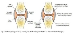 Rheumatoid Arthritis Facts