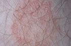 facts about Ringworm