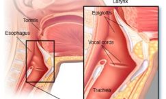 Facts about Throat Cancer